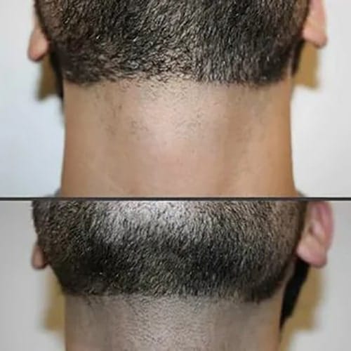 عکس قبل و بعد از لیزر موهای زائد آقایان