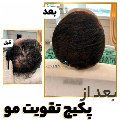 نمونه کار مزوتراپی مو جهت تقویت موی سر