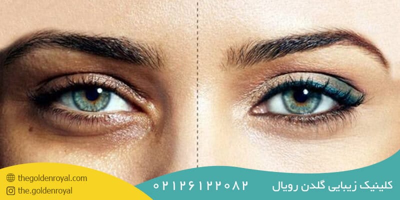 درمان سیاهی زیر چشم با مزوتراپی