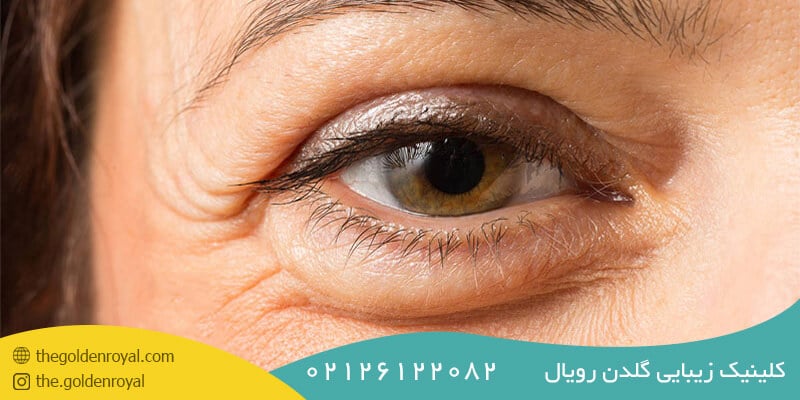 مراقبت های پس از مزوتراپی چشم
