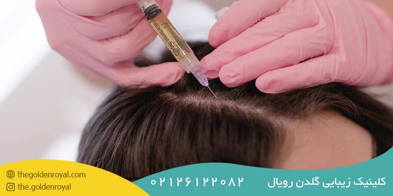 مزایای درمان ریزش مو با روش مزوتراپی