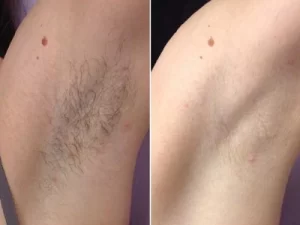 before and after body laser 1