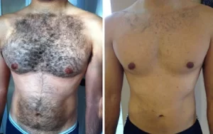 before and after body laser removal 1
