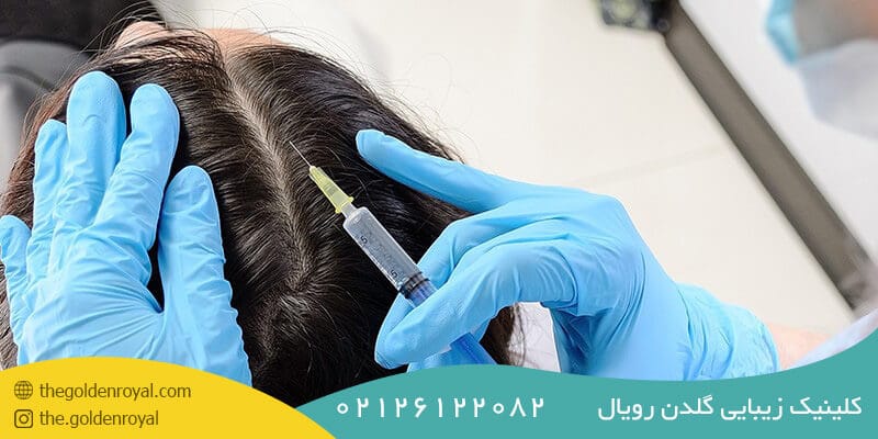روش درمان ریزش مو با مزوتراپی