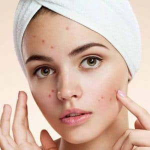 5 روش معجزه آسا برای درمان جوش صورت