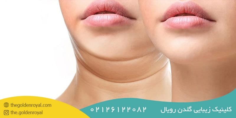افتادگی پوست غبغب