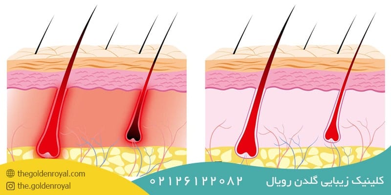 لایه های تشکیل دهنده فولیکول مو