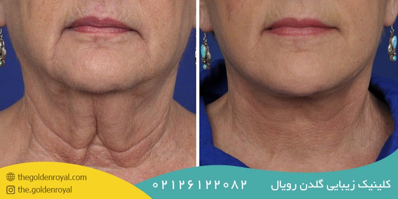 لیفت گردن بدون جراحی