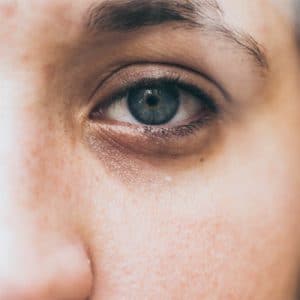 بهترین روش های درمان گودی زیر چشم که باید بدانید