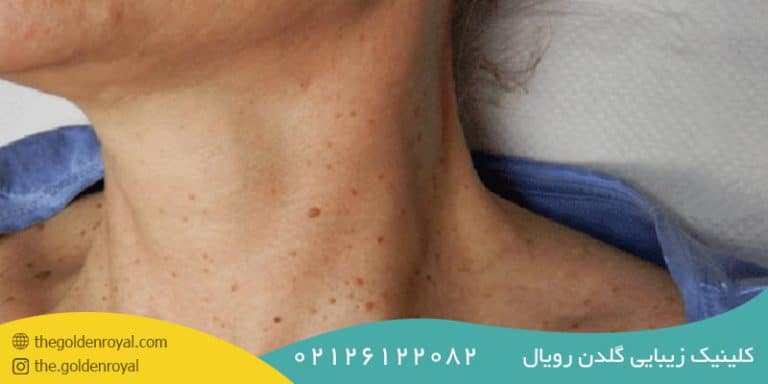 معرفی انواع خال و زگیل | گلدن رویال
