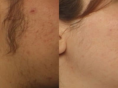 Vectus Hair removal before and after 4 min 1