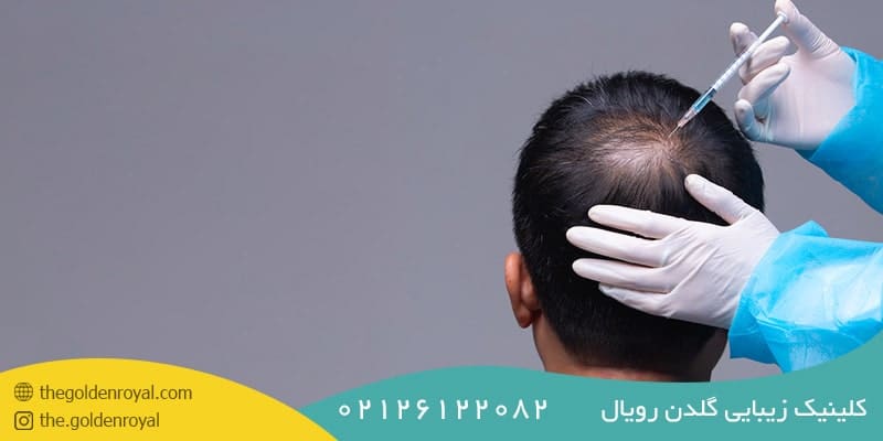 مراحل انجام درمان ریزش مو با مزوتراپی 