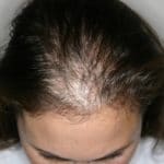 درمان ریزش مو جلو سر برای آقایان و خانم ها