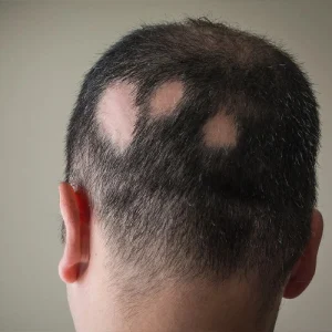 درمان ریزش مو سکه ای: امیدی برای بازگشت موهای از دست رفته