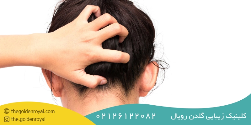 پوست‌های چرب و حساس (درماتیت سبورئیک) یکی از علل شوره سر است